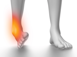 捻挫と挫傷の違いは何ですか?